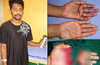 Mangaluru: Four amputated fingers rejoined at AJ Hospital